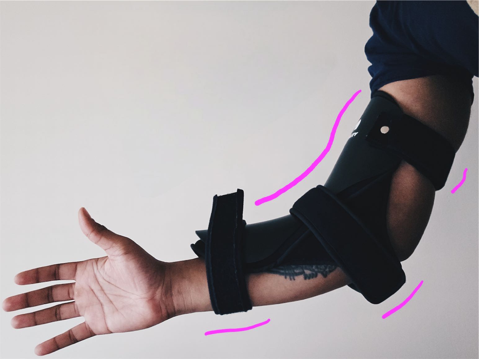 Photo of my right arm while wearing an arm brace. Annotated accents around the brace in pink